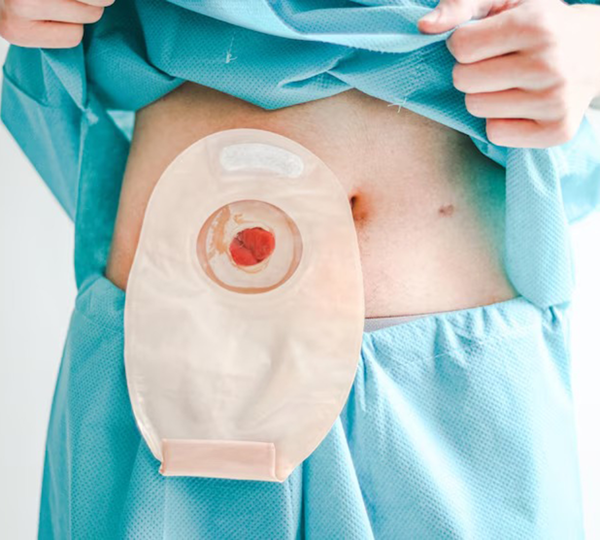 Ostomia e curativos são temas de capacitação de enfermeiros de Tatuí ...