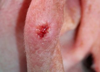 Lesão discreta, risco real: como identificar o carcinoma basocelular