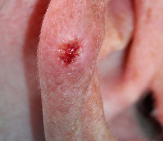 Lesão discreta, risco real: como identificar o carcinoma basocelular